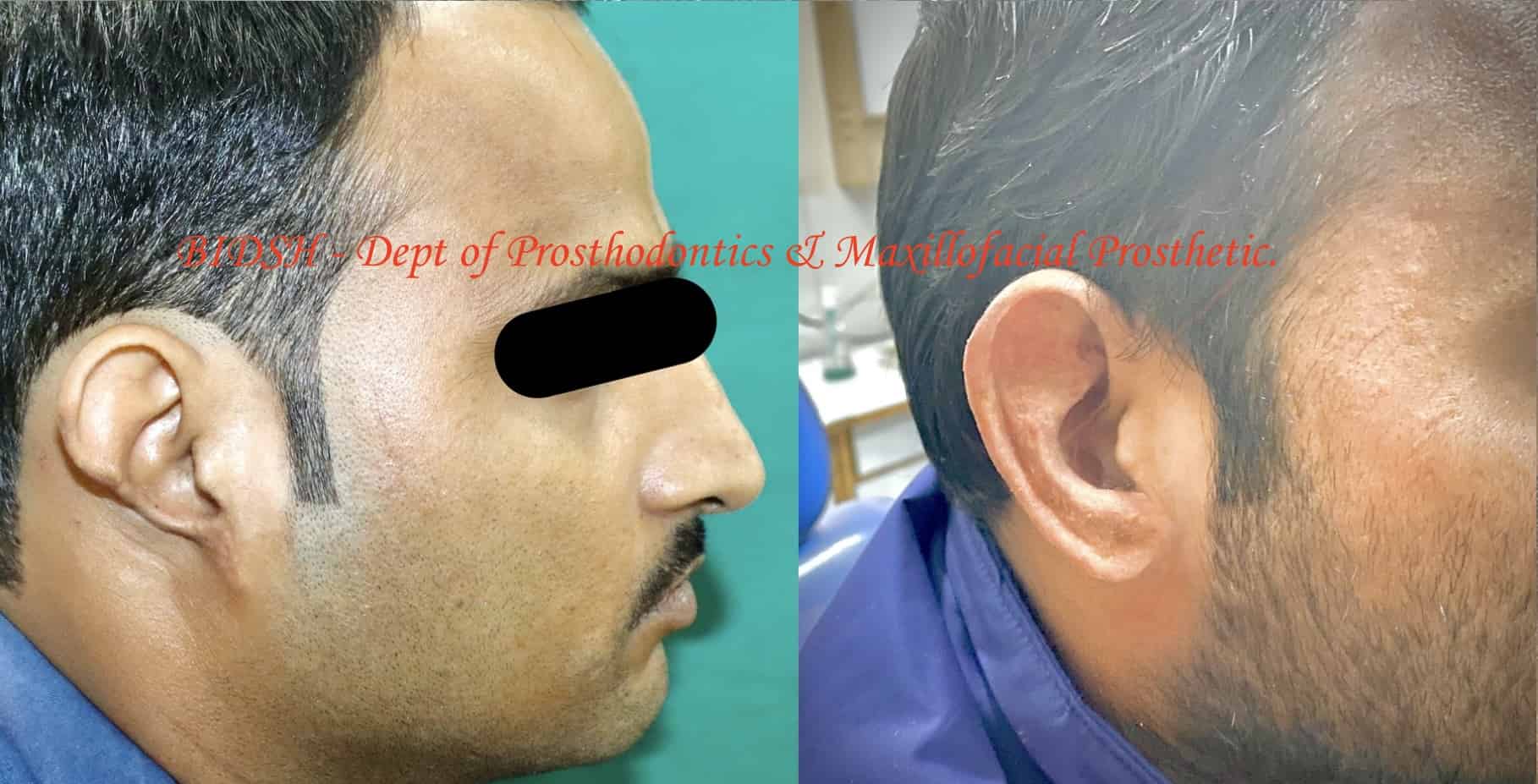 Ear Prosthesis